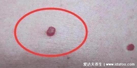 年轻人樱桃状血管瘤图片，身上出现红色痣就需要注意了