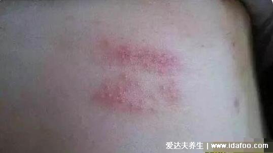 带状孢疹前期图片，身体单侧长带状小水疱有剧烈痛感