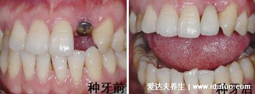 种植牙有什么风险和后遗症，五大坏处影响口腔(谨慎种植)