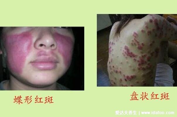 红斑疮前期图片，面部有蝶形红斑伴随关节酸疼/脱发等症状