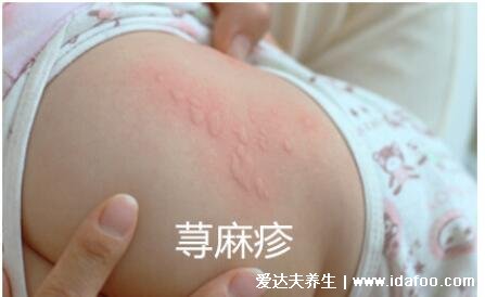 婴儿红疹图片初期症状图片，可能是湿疹（婴幼儿易得）