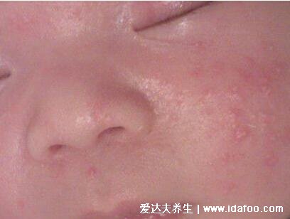 婴儿红疹图片初期症状图片，可能是湿疹（婴幼儿易得）
