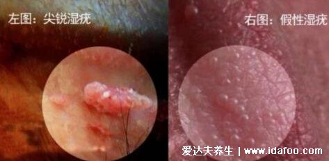 假疣和真疣的区别图，真疣容易传染(发现感染应立即就医)