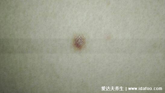 早期皮肤纤维瘤图片初期症状图，褐色圆形的硬疙瘩非常影响美观