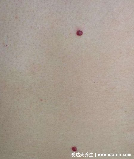  正常红痣的图片，分布于躯干的红色痣（中老年人易有）