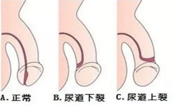 尿道下裂是什么病图片及症状，男性多发的先天畸形病(5种类型)