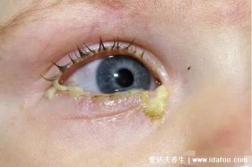 真实初期红眼病图片及症状，眼睛发红眼屎又黏又多(会传染)