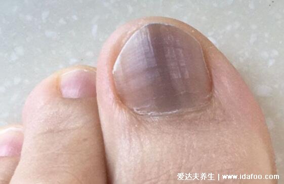 良性甲母痣图片，大于5毫米警惕癌变成指甲黑色素瘤