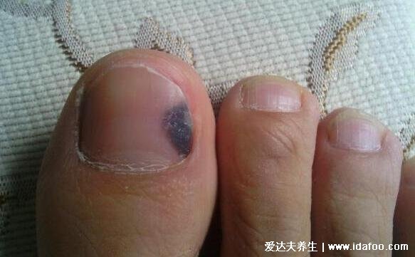良性甲母痣图片，大于5毫米警惕癌变成指甲黑色素瘤