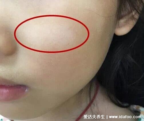 小孩缺维生素脸上白斑图片，还有可能是白色糠疹(家长必看)