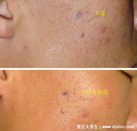 脸上粉瘤手术后疤痕图片，7天拆线2个月基本看不出疤痕