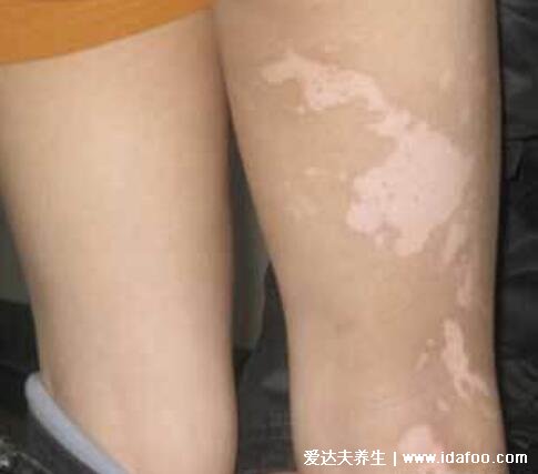 腿上白斑早期症状图片，白癜风光滑不脱屑还会增大变白