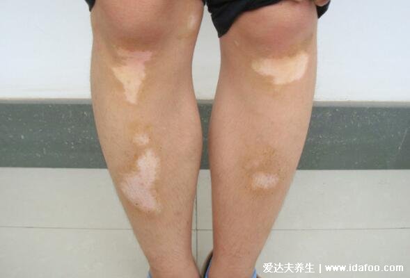 腿上白斑早期症状图片，白癜风光滑不脱屑还会增大变白