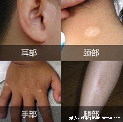 皮肤色素减退形成的白斑图片，白癜风/白化病/汗斑/白色糠疹
