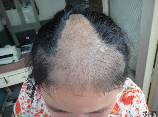 早期头皮癣症状图片，4种类型中黄癣传染性强脓癣永久性脱发