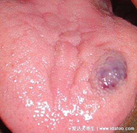 舌下血管瘤早期图片及症状，初期舌头上有紫红色的柔软肿物