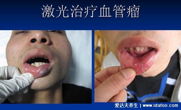 舌下血管瘤早期图片及症状，初期舌头上有紫红色的柔软肿物