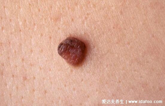 长在皮肤表面的瘤图片，最严重的是黑色素瘤会致命
