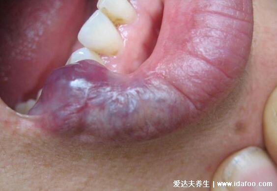 唇部血管瘤初期图片，紫红色质地软的肿瘤(按压会褪色缩小)
