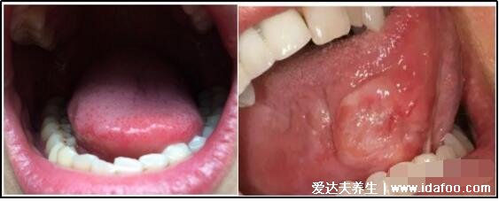 口腔初期小疣体图片，口腔尖锐湿疣发病率很低不要误诊(有图慎点)