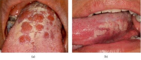 口腔初期小疣体图片，口腔尖锐湿疣发病率很低不要误诊(有图慎点)