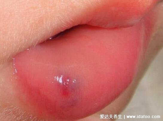 口腔血管瘤最初期的图片，有3大类型危害触目惊心(长紫红色肿物)