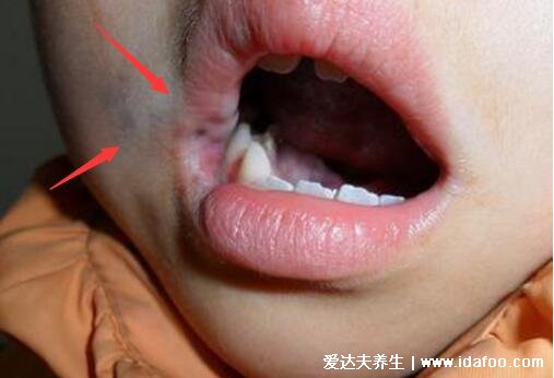 口腔血管瘤最初期的图片，有3大类型危害触目惊心(长紫红色肿物)