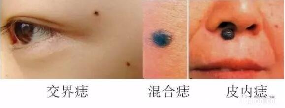 各种皮肤肿瘤图片早期图片，3种良性4种恶性肿瘤症状合集