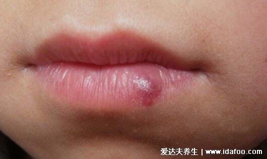 成人唇部血管瘤初期图片及症状，紫红色的柔软瘤子会增大出血