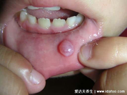 疱疹和上火水泡的区别图片，小水泡密集是疱疹(上火水泡较大)