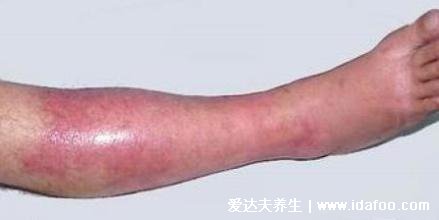 皮肤病丹毒图片的症状图片，出现明显大片红斑(不及时治疗危害大)