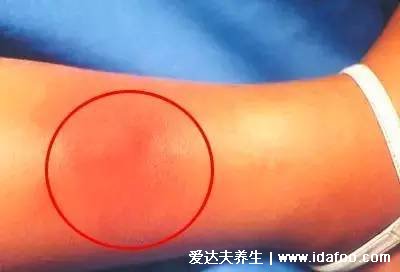 皮肤病丹毒图片的症状图片，出现明显大片红斑(不及时治疗危害大)