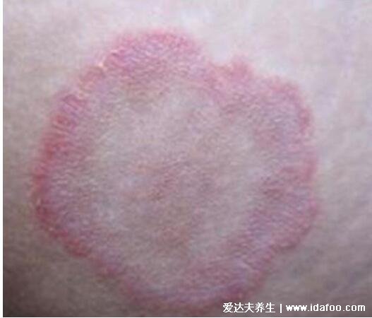 皮肤病圆癣的症状和图片，出现铜钱形状的红斑(有屑瘙痒)