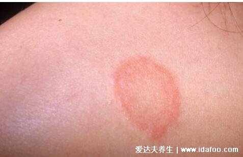 皮肤病圆癣的症状和图片，出现铜钱形状的红斑(有屑瘙痒)
