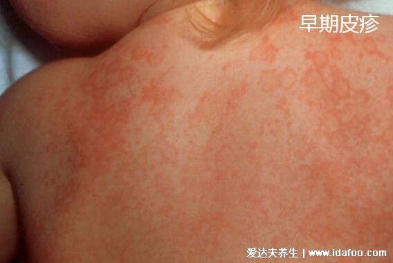 川崎病皮疹什么样图片，初期红疹子遍布全身注意和猩红热区分