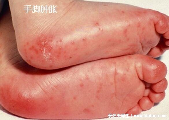 川崎病皮疹什么样图片，初期红疹子遍布全身注意和猩红热区分