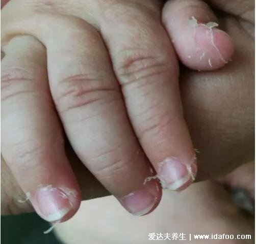 不典型川崎病手指脱皮图片特征，退烧后手脚开始脱皮伴随硬性肿胀