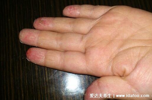 不典型川崎病手指脱皮图片特征，退烧后手脚开始脱皮伴随硬性肿胀