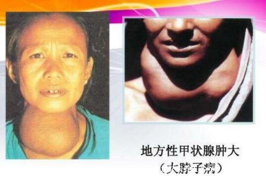 女性大脖子病图片，脖子明显粗壮但早期无症状(体检可发现)