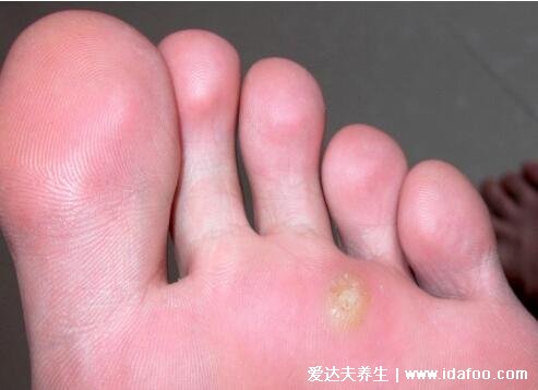 跖疣图片初期图片，丘疹变为黄角质粗糙有黑点(脚底脚缝会有)