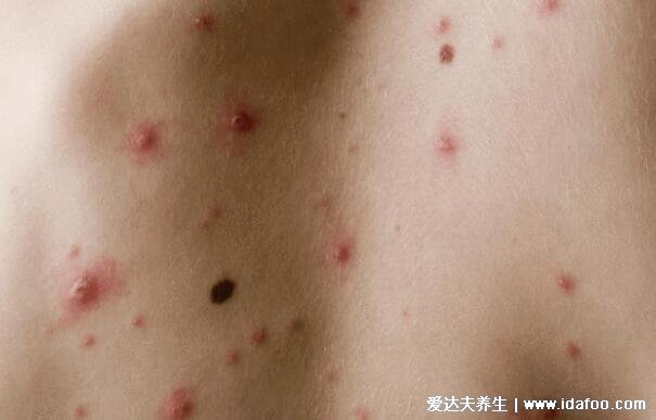 初期艾滋病皮疹图片，像普通皮疹长红点/水疱(没有特定症状)