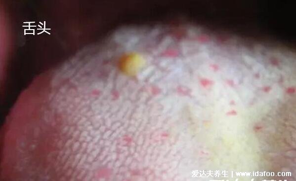 初期艾滋病皮疹图片，像普通皮疹长红点/水疱(没有特定症状)