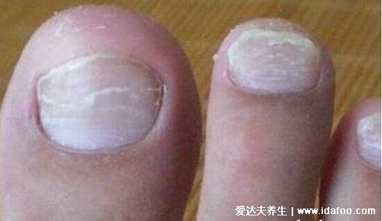 灰指甲的前兆图片，出现4大症状时及时治疗(附治疗方法)