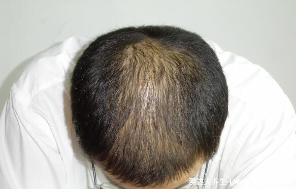 米诺地尔酊真的可以生发吗，拯救无数斑秃患者(1个月见效)