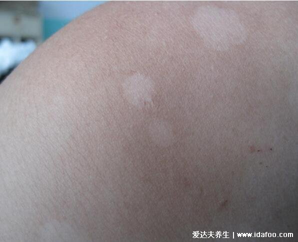 白斑癣的早期症状图片，有鳞屑且可能会痒(经常出汗要注意)