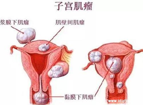 吃中药10天排出子宫肌瘤，需要注意这两点(中药可能会改善)