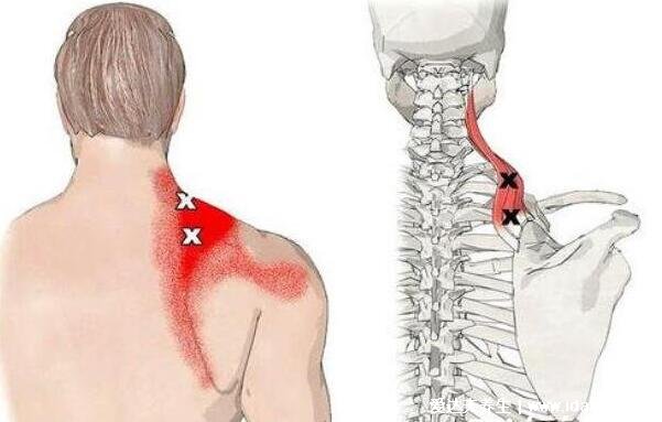 后背疼痛是什么原因有哪些，后背疼痛位置图及病情对照图(6大疾病)