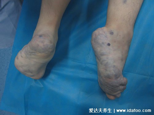 脚上长血管瘤初期图片，颜色是蓝紫可能是蔓状血管瘤