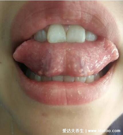 口腔舌系带疣体图片，有数个豆大菜花状疣体(声音可能会嘶哑)