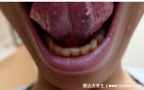 口腔舌系带疣体图片，有数个豆大菜花状疣体(声音可能会嘶哑)